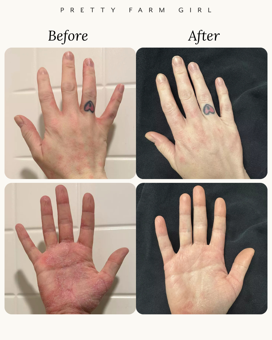 Before and after comparison of a hand with visible skin conditions on a tiled wall background. eczema and psoriasis on hands. Pretty Farm Girl | Pure Tallow + Honey Fragrance Free Handmade Tallow and Goat Milk Soap Bar for skin