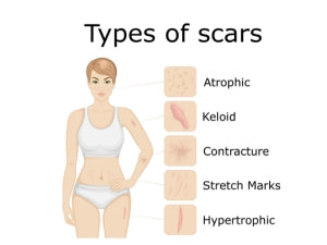 Mama Scar Salve- Treatment for Stretch Marks and C-Section Recovery