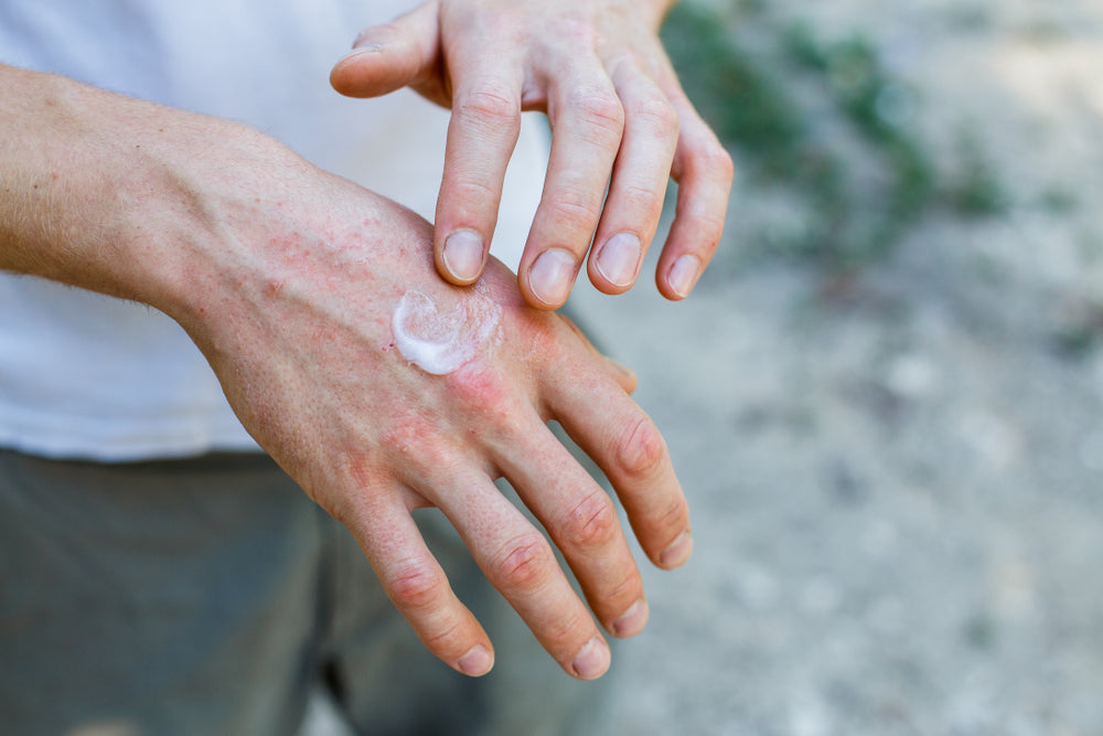 soothing comfrey cream on hands for moisture, and skin muscle support