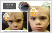 face scrape wound healing of child with comfrey salve by ssf organics serendipitous summer farms Organic Comfrey Salve - Organic Comfrey  or bone healing and skin muscle and arthritis relief comfrey salve | Penetrex | Joint Pain | Arthritis | Eczema | Psoriasis | Cyst | Infection | antifungal | Sore | Rash | Bite | Sting | Bee Venom |