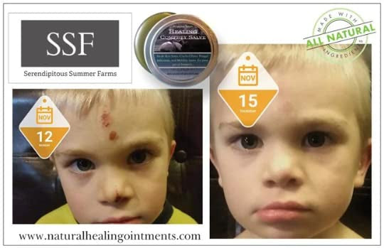 face scrape wound healing of child with comfrey salve by ssf organics serendipitous summer farms Organic Comfrey Salve - Organic Comfrey  or bone healing and skin muscle and arthritis relief comfrey salve | Penetrex | Joint Pain | Arthritis | Eczema | Psoriasis | Cyst | Infection | antifungal | Sore | Rash | Bite | Sting | Bee Venom |